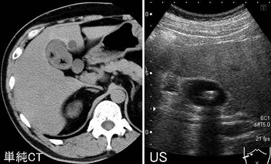 胆のうの中にあった石 胆石症、総胆管結石症｜オリンパス おなかの健康ドットコム